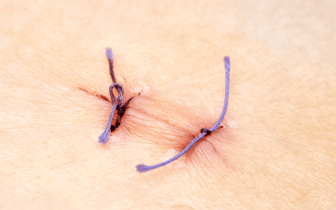 zo geneest jouw wond